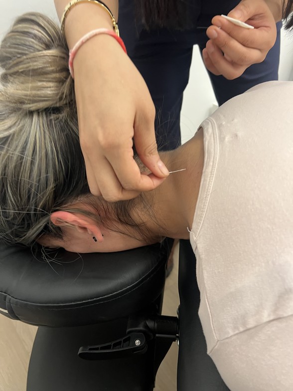 Acupuncture vs. Dry Needling 