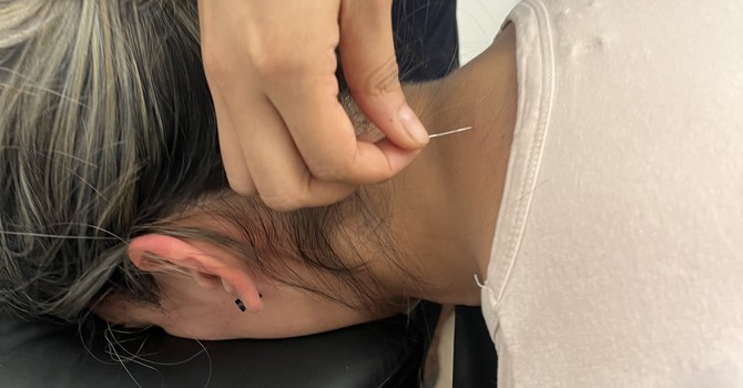 Medical Acupuncture & Dry Needling