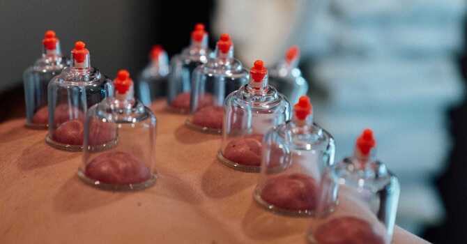 Cupping Therapy image