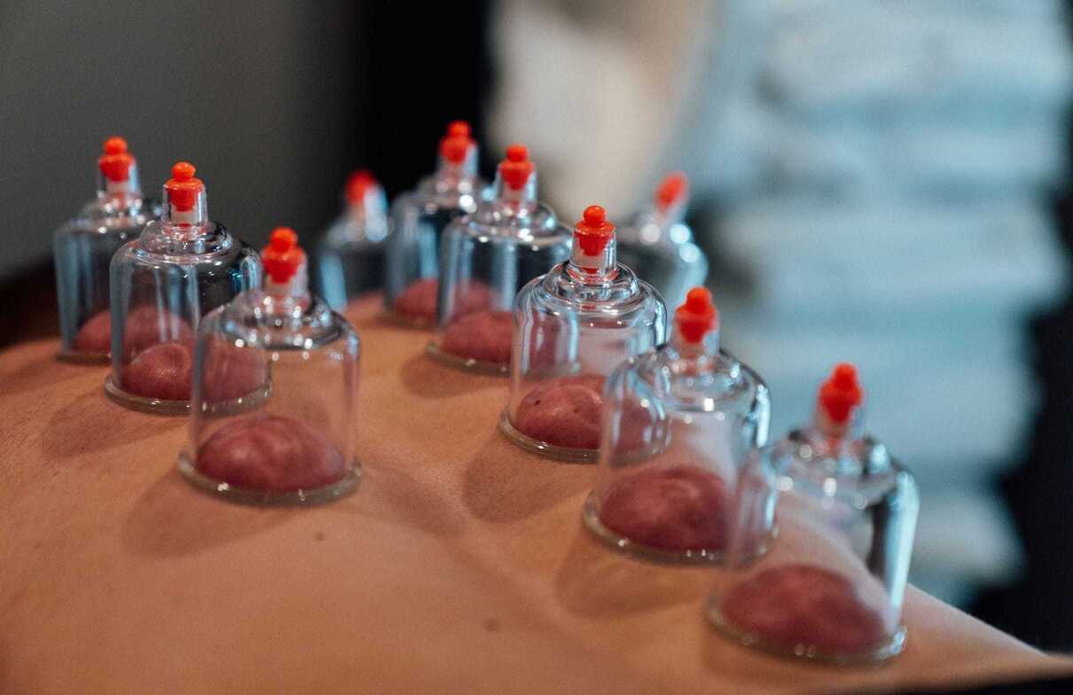 cupping therapy